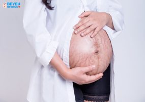 Mẹo chữa rạn da cho mẹ từ những nguyên liệu đơn giản tại nhà.