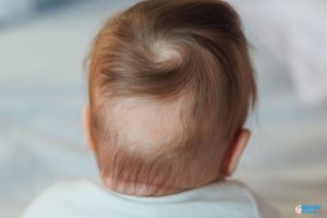 Trẻ bị rụng tóc vành khăn có phải do bệnh lý?