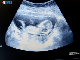 Đo độ mờ da gáy khi mang thai quan trọng như thế nào?