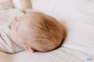 Vì sao trẻ sơ sinh lại bị “cứt trâu” trên đầu?