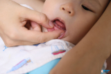 Nanh sữa là gì? Trẻ bị nanh sữa có nguy hiểm không?