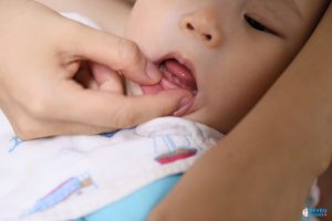 Nanh sữa là gì? Trẻ bị nanh sữa có nguy hiểm không?