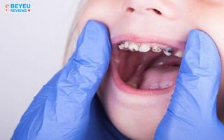 Tại sao bé chăm đánh răng mà vẫn sâu răng?