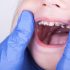 Mách mẹ một số mẹo trị đau răng cho bé đơn giản tại nhà